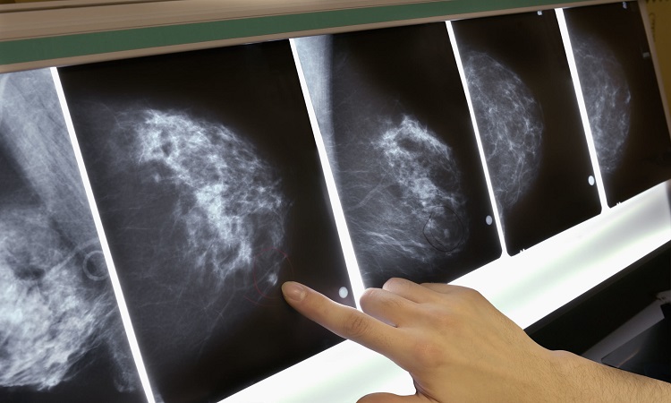 MIT desarrolla una inteligencia artificial que predice cáncer de mama hasta con cinco años de anticipación
