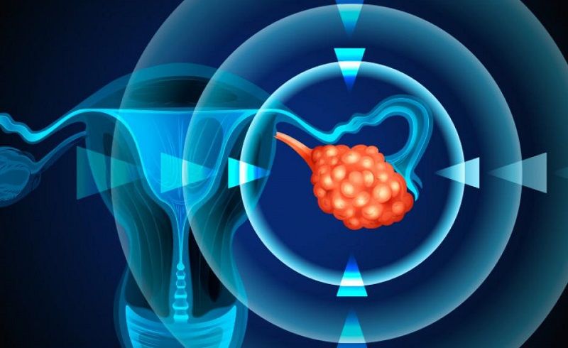 Infografía: seis puntos para sobrevivir al Cáncer de Ovario