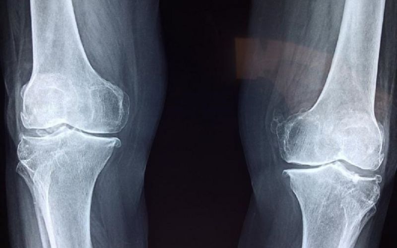 Inteligencia artificial detecta la osteoartritis años antes de que se desarrolle