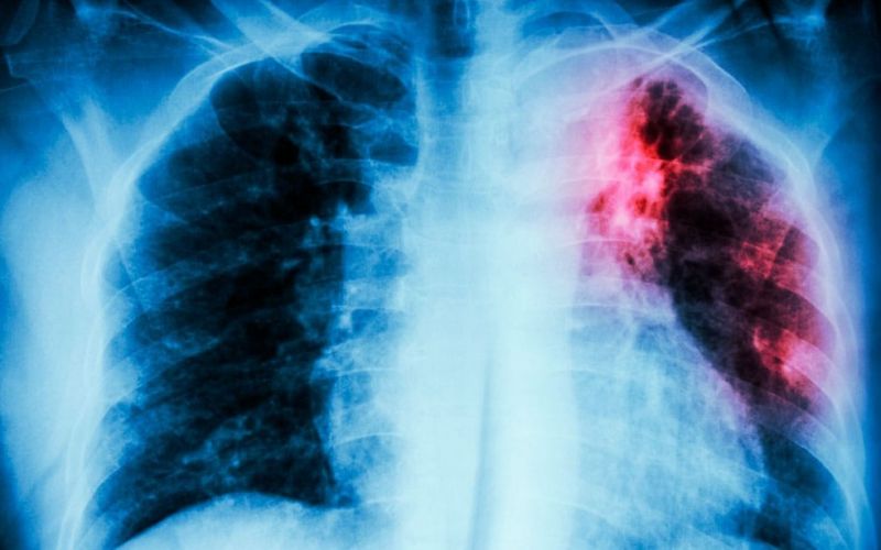 Pide el Senado fortalecer campañas contra tuberculosis