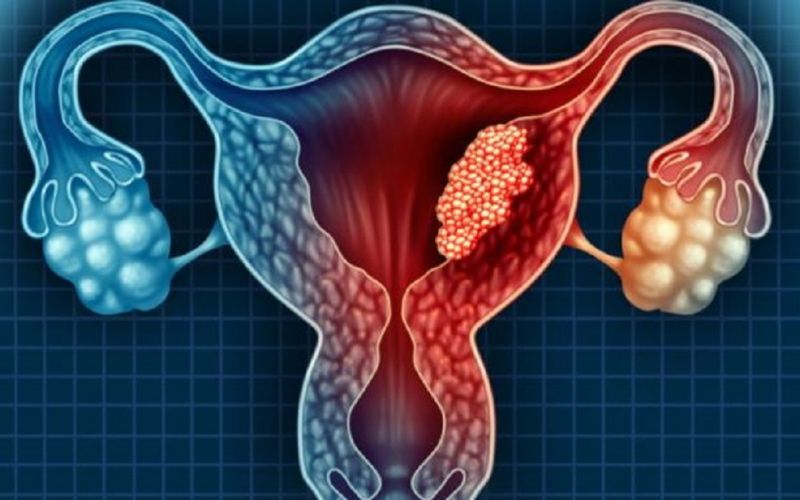 Aumenta el número de mujeres jóvenes con cáncer cervicouterino